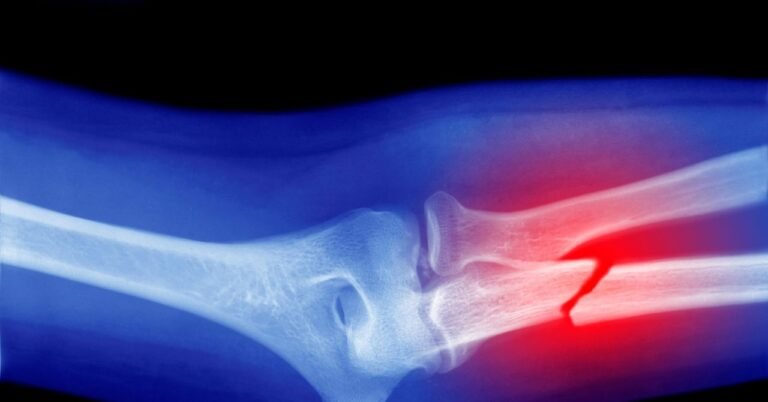 Microplastics Could Be Weakening Your Bones, Research Suggests Microplastics Could Be Weakening Your Bones, Research Suggests