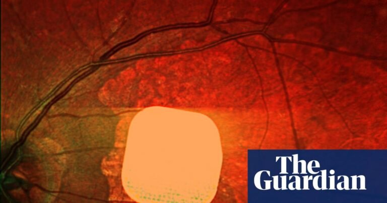 Experts hail ‘remarkable’ success of electronic implant in restoring sight | Medical research