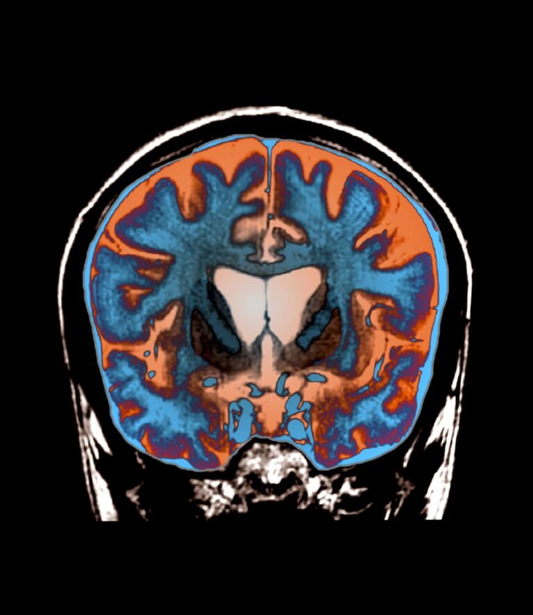 First Treatment that Slows Huntington's Disease Comes after Years of Heartbreak