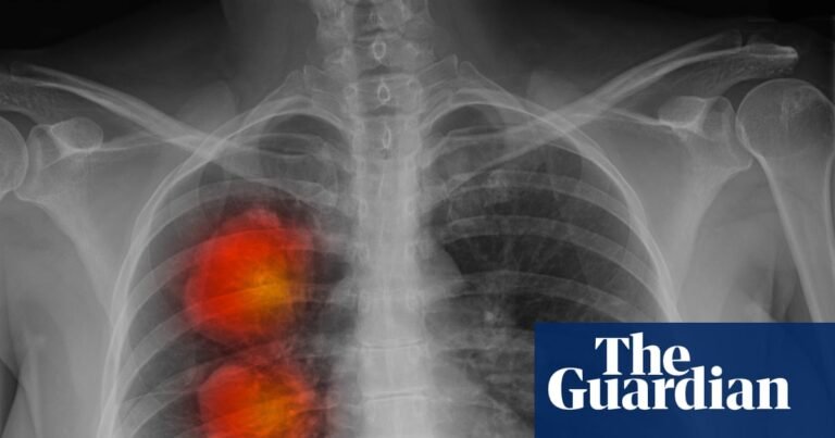 More than 60,000 cancer patients in England ‘not getting necessary radiotherapy’ | Cancer