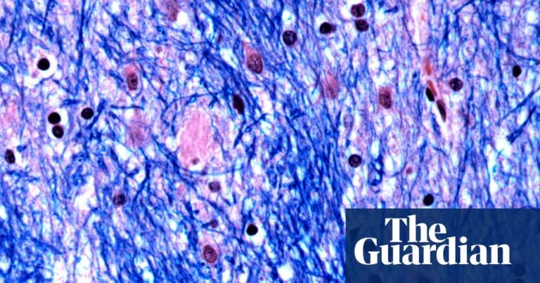 My dad, his ‘incurable’ disease, and hope at last - podcast | Huntington's disease