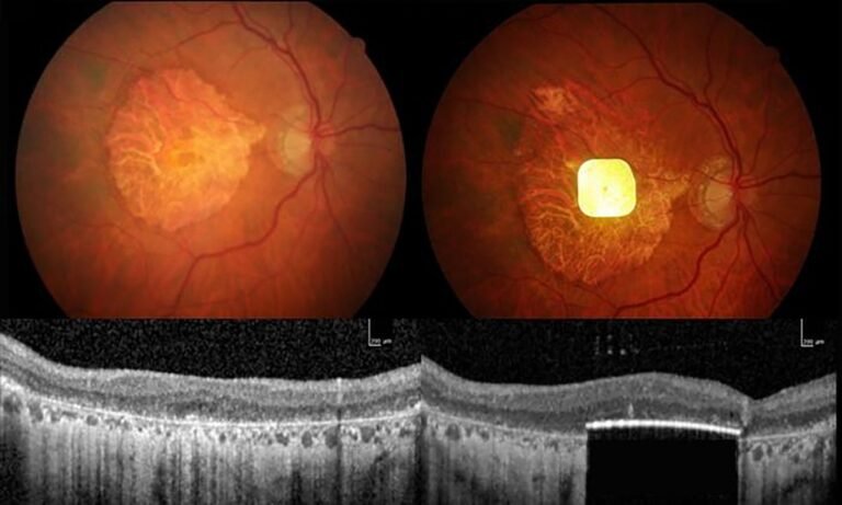 Retinal Implant Allows People with Blindness to Read Again in Small Trials