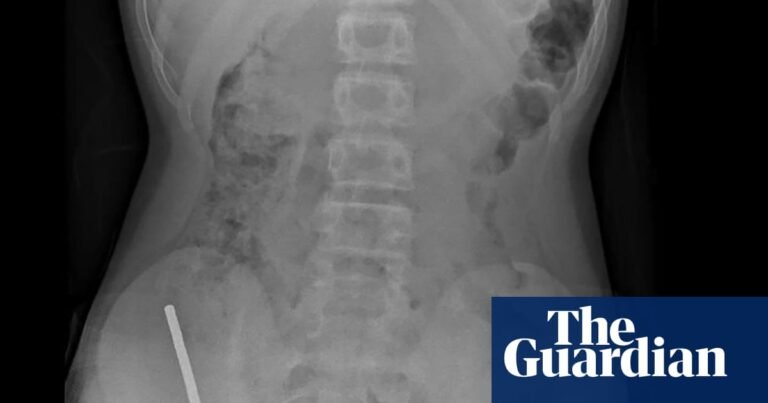 Surgeons remove up to 100 magnets from New Zealand teenager’s intestines | New Zealand Surgeons remove up to 100 magnets from New Zealand teenager’s intestines | New Zealand