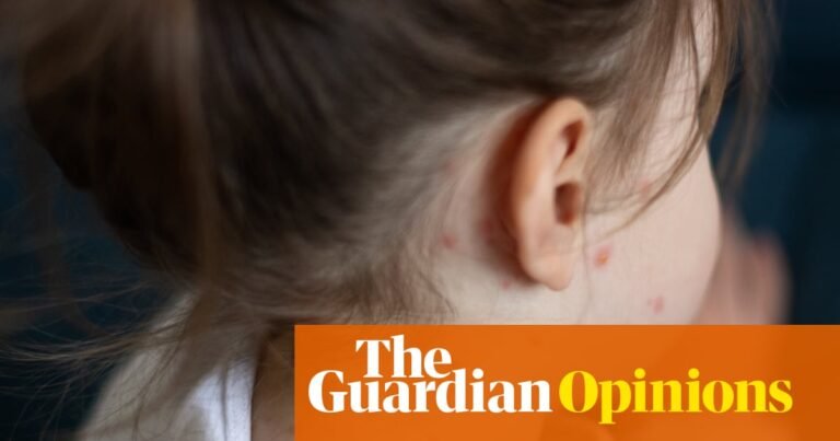 Ignore the sceptics: with this new vaccine, chickenpox could become a thing of the past | Wes Streeting