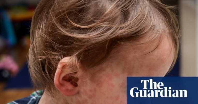 Measles: how does it spread and how can I protect my child? | Infectious diseases Measles: how does it spread and how can I protect my child? | Infectious diseases