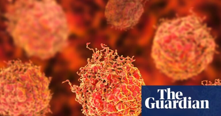 Researchers praise ‘stunning’ results of new prostate cancer treatment | Prostate cancer Researchers praise ‘stunning’ results of new prostate cancer treatment | Prostate cancer