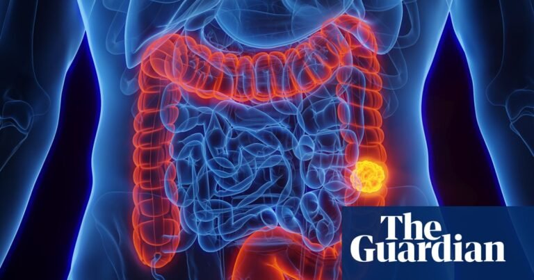 What is colorectal cancer and is it preventable? | Well actually What is colorectal cancer and is it preventable? | Well actually