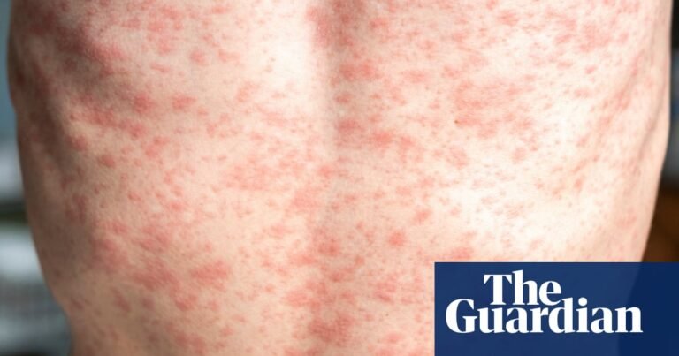 How contagious is measles and what are the symptoms? | Well actually