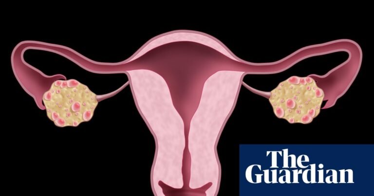 NHS urged to update website after renaming polycystic ovary syndrome | NHS NHS urged to update website after renaming polycystic ovary syndrome | NHS