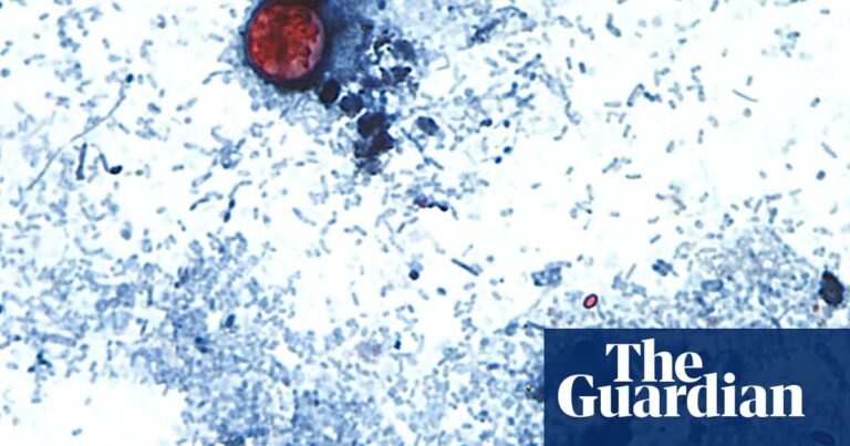 US outbreak of parasite causing ‘watery diarrhea’ rises to more than 2,800 cases | US healthcare US outbreak of parasite causing ‘watery diarrhea’ rises to more than 2,800 cases | US healthcare
