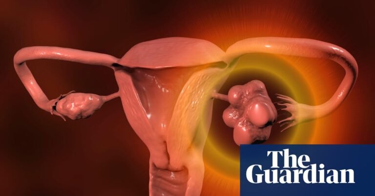 Women with irregular periods should be checked for PMOS, NHS says | Health Women with irregular periods should be checked for PMOS, NHS says | Health