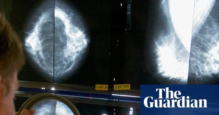 GPs’ breast cancer guidelines ‘miss’ 95% of women who will develop disease | Breast cancer
