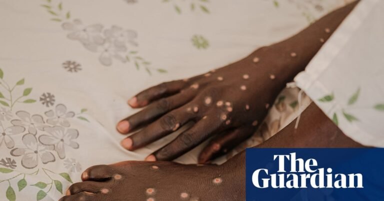 Mpox is back – and in new countries. How can this outbreak be contained? | Global health Mpox is back – and in new countries. How can this outbreak be contained? | Global health
